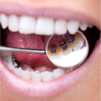 Clear braces