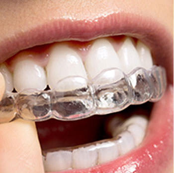 Invisalign