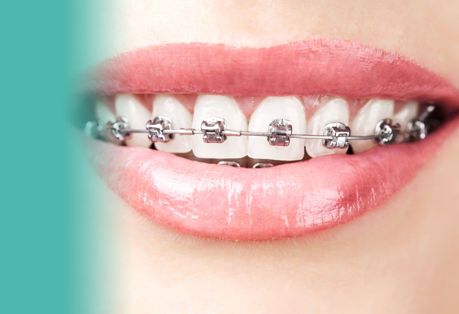 Metal braces